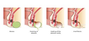 abses perianal